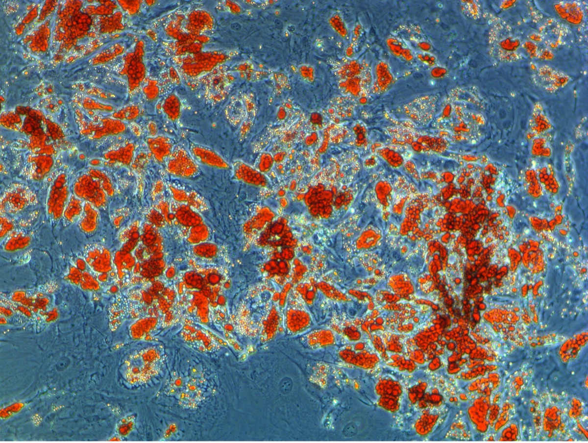 Adipocytes, Obesity and the Multiple Myeloma Microenvironment